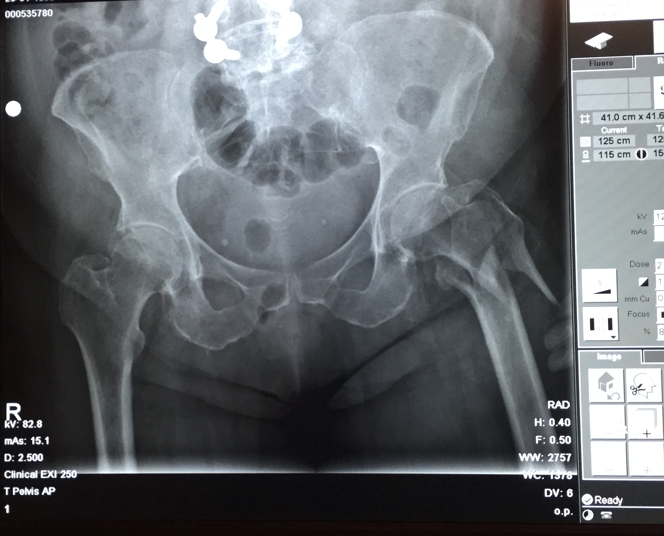 Hip Fracture Pelvis.png
