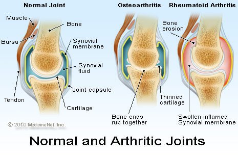 arthritic_joints.jpg