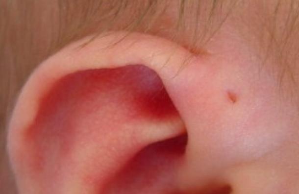 senopreauricular.jpg