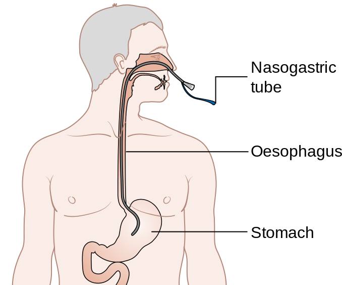 Diagram_showing_the_position_of_a_nasogastric_tube_CRUK_340.png