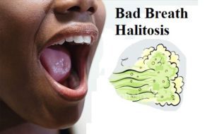 halitosis-300x190.jpg