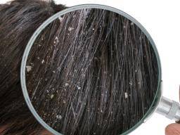 dandruff-close-up.jpg