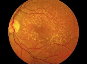 Age-related Macular Degeneration.jpg