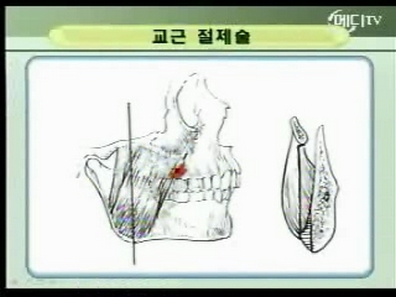 교근절제술 부기.jpg