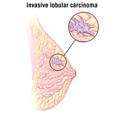 Invasive-Lobular-Carcinoma.jpg