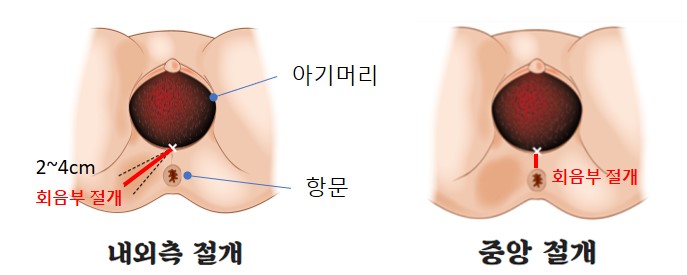 내외측절개 중앙절개.jpg