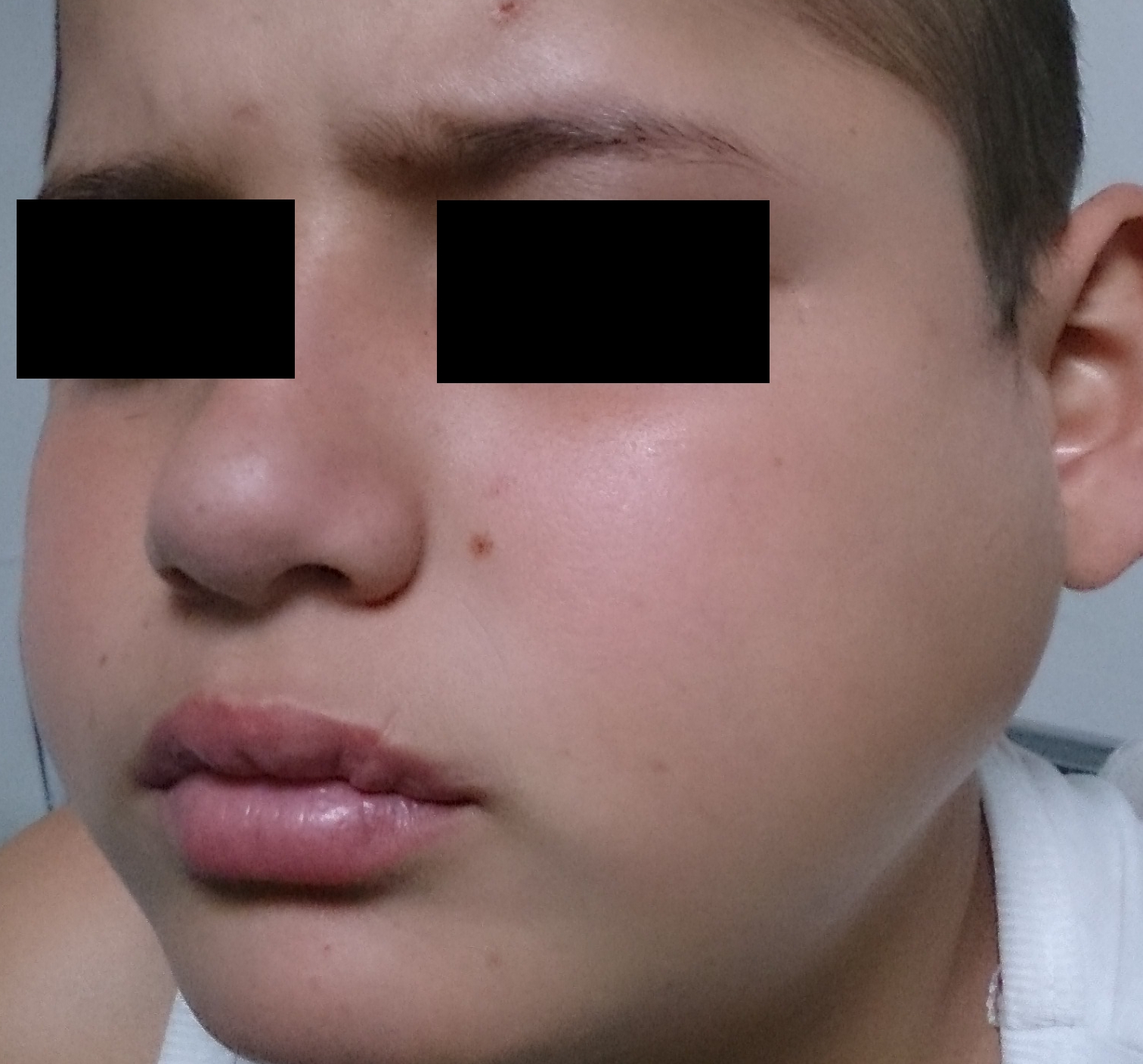 Parotiditis_(Parotitis;_Mumps).JPG