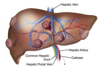 liver-tumors.jpg