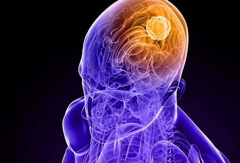 493ss_getty_rf_brain_cancer_illustration.jpg