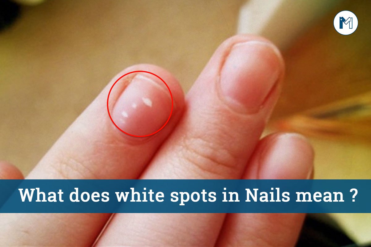 What are those white spots on the nails? — Steemit