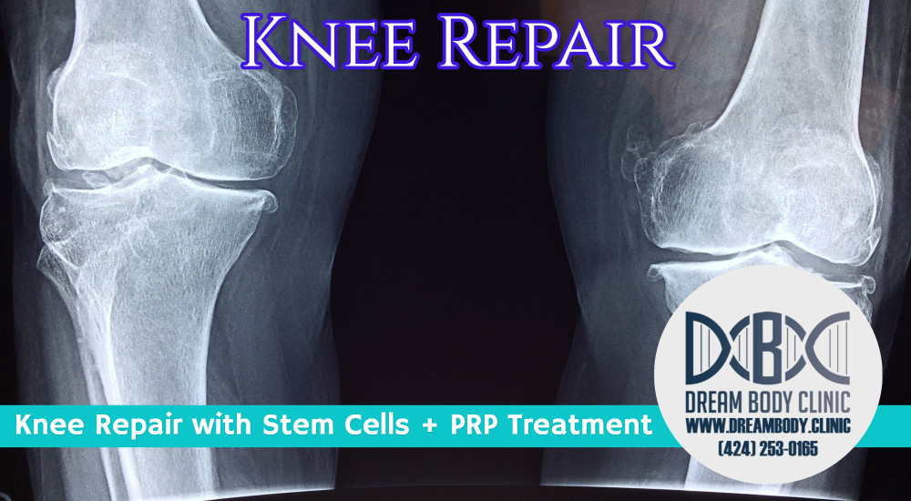 stem cell knee repair plus prp dreambody clinic.jpg