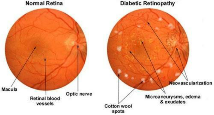 Difference-between-Normal-Retina-and-Diabetic-Retinopathy.png