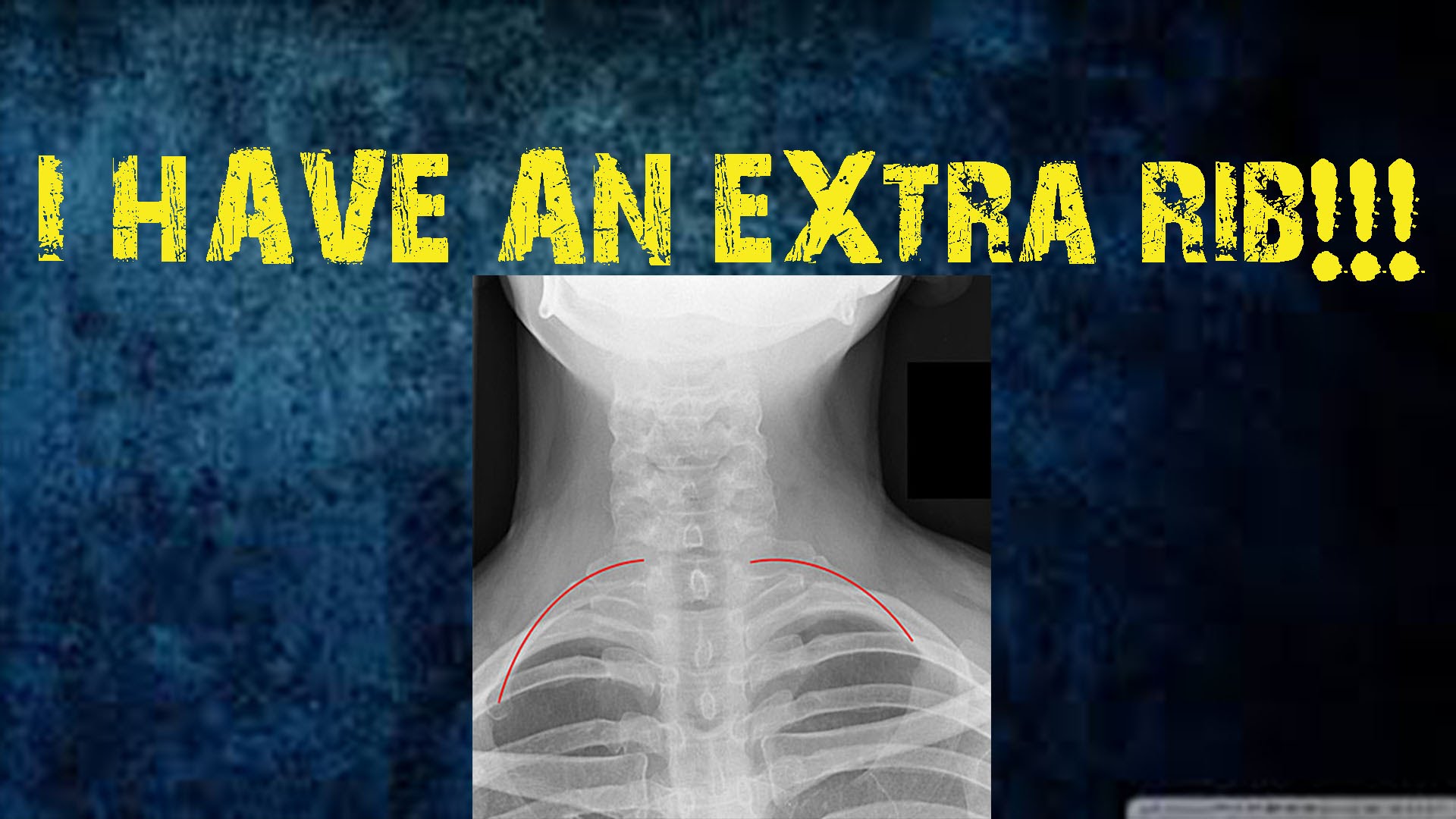 Extra rib is also called cervical rib , sometimes known as “neck… by igoran...