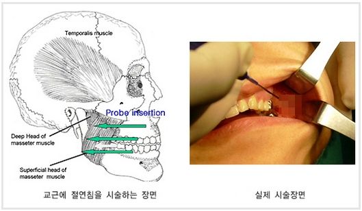 교근축소술 효과.jpg