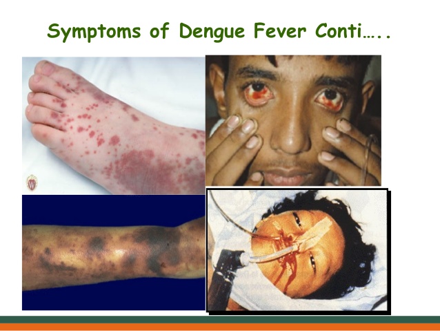 dengue-fever-at-a-glance-12-638.jpg