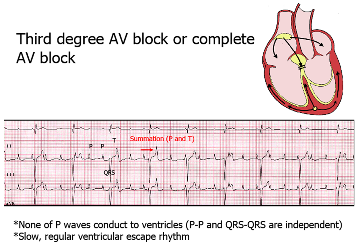 third degree block.png