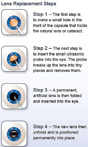 cataract-surgery-steps.jpg