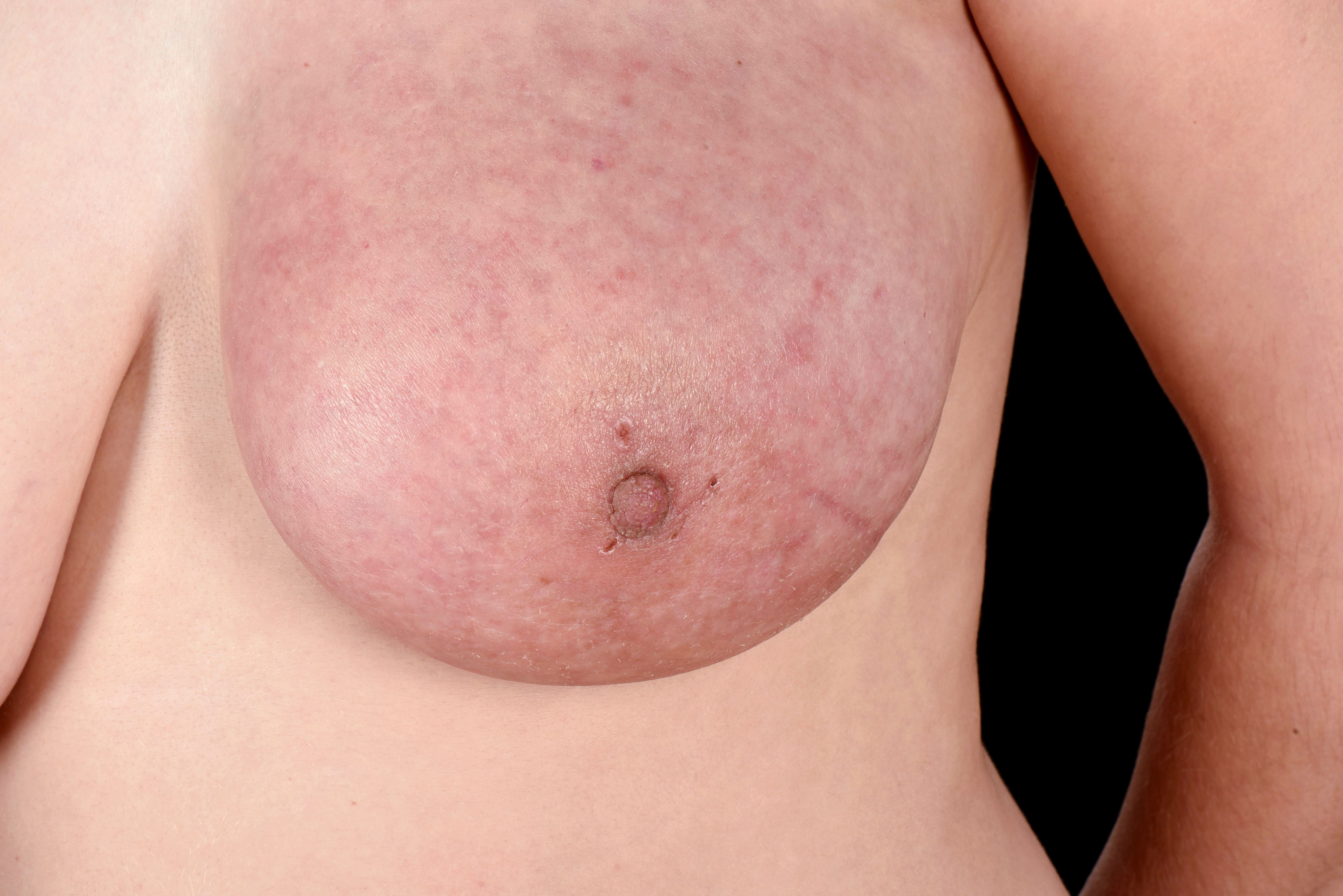 means that a number of breast cells are beginning to multiply abnormally. 