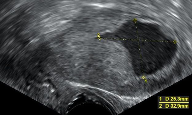 Endometrial_fluid_accumulation,_postmenopausal.jpg
