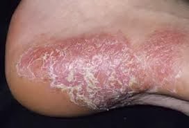 Flexural eczema.jpg