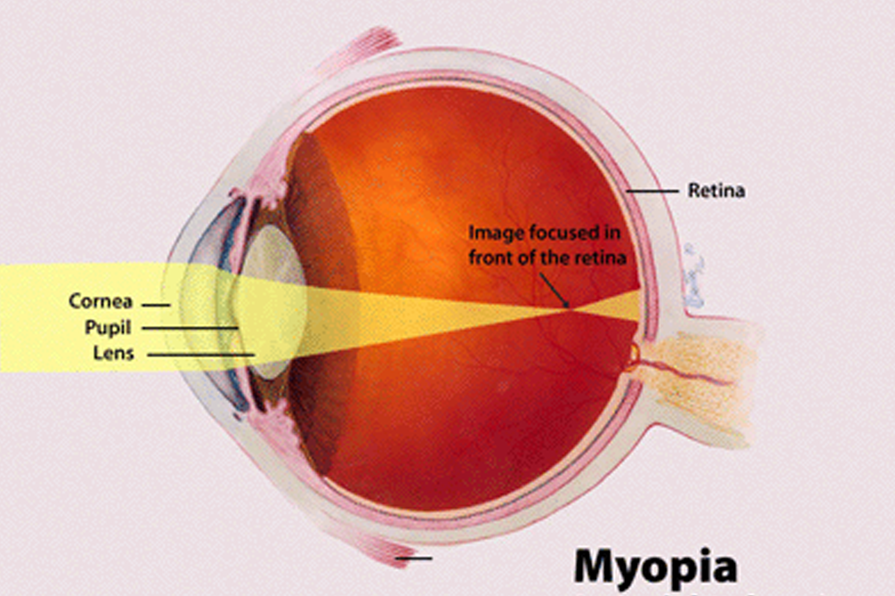 Myopia.png