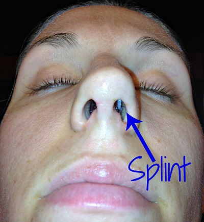 What You Need to Know - Explained with Open Rhinoplasty
