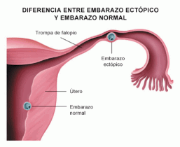 embarazo-ectopico-257x210.png