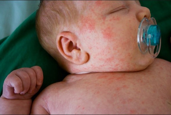 common-baby-rashes-acne-to-eczema-is-it-a-milk-allergy-baby-rash