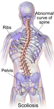 180px-Blausen_0785_Scoliosis_01.png
