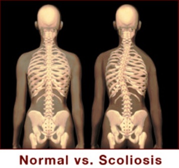 Scoliosis_1.jpg