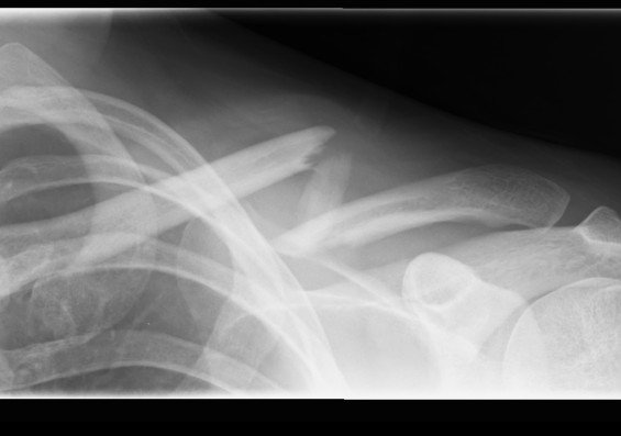 Displaced Clavicle Fracture.jpg