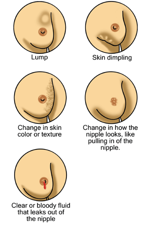 En_Breast_cancer_illustrations.png