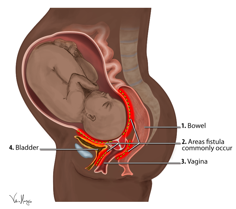 Obstetric_Fistula_Locations_Diagram.png