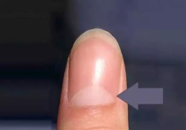 Health Tips: This is the secret of the white crescent in the nails .. and  its relation to health — Steemit
