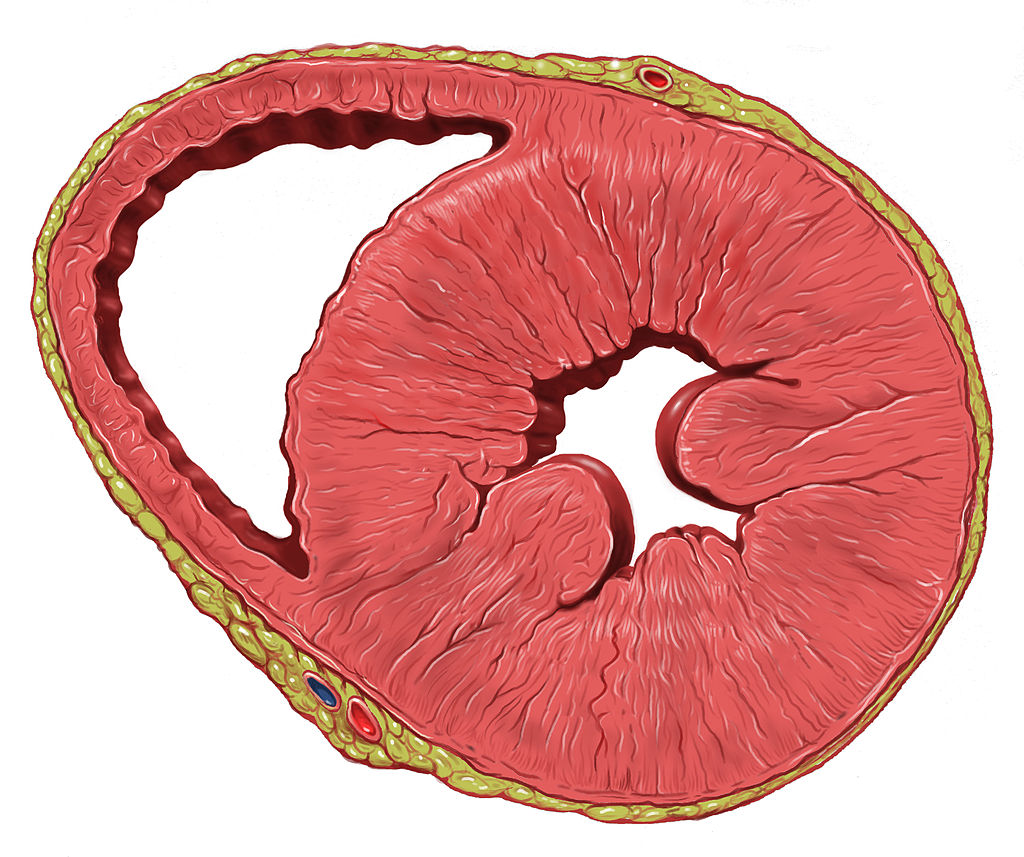 1024px-Heart_left_ventricular_hypertrophy_sa.jpg