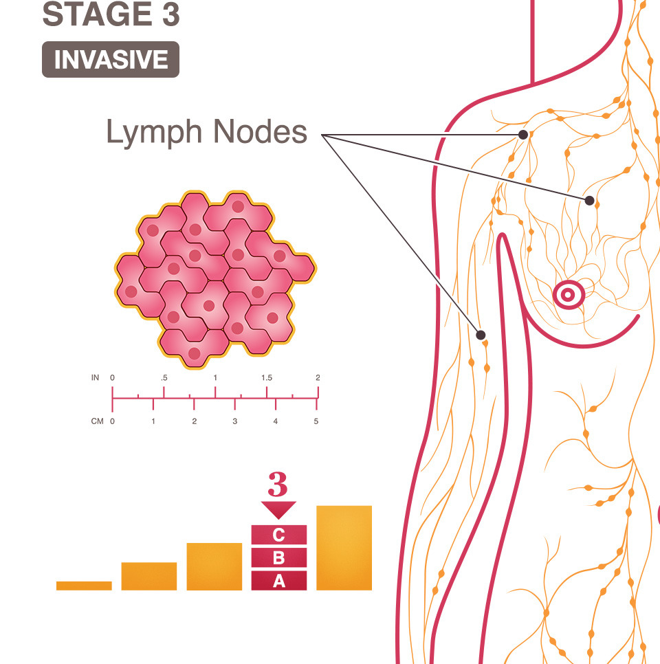 What Does Grade 3 Breast Cancer Mean