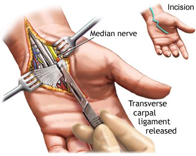 carpal4.jpg