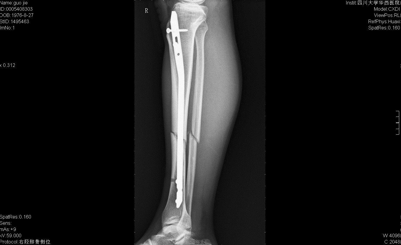 右小腿中段闭合性骨折 利用健肢固定 Steemit