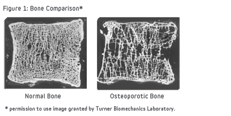 Bone_Comparison_of_Healthy_and_Osteoporotic_Vertibrae.png