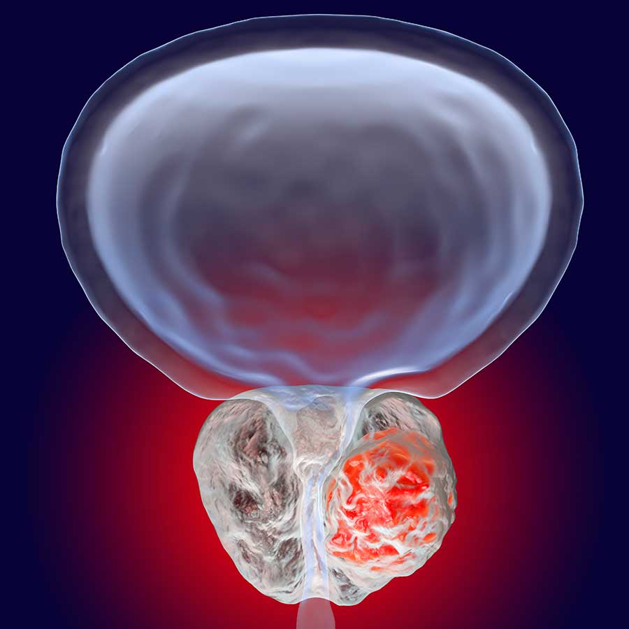 prostate-tumor.jpg