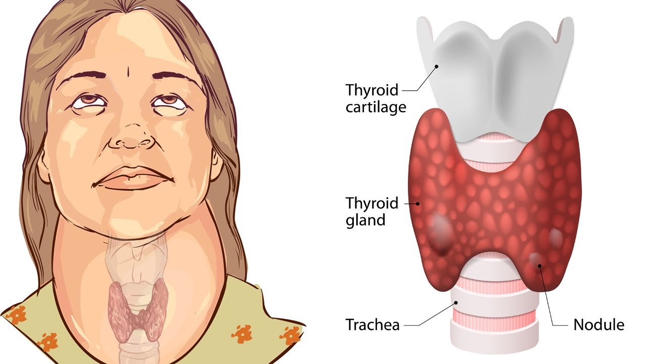 Щитовидная железа девушка