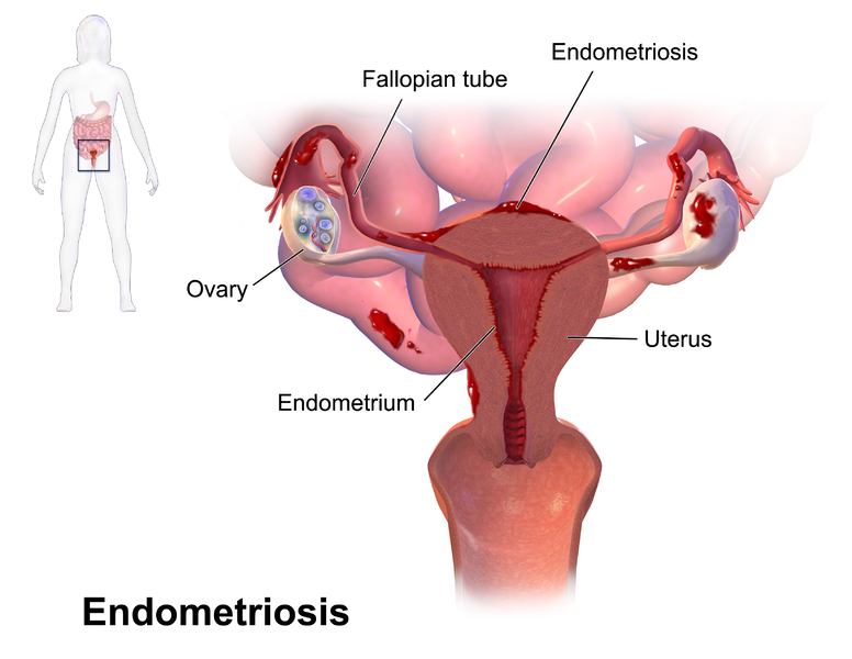 Blausen_0349_Endometriosis.png