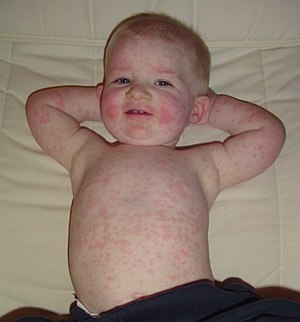 300px-Fifth_disease.jpg