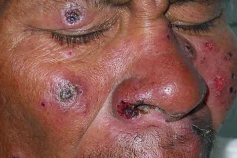 Leishmaniasis 02 (1).jpg