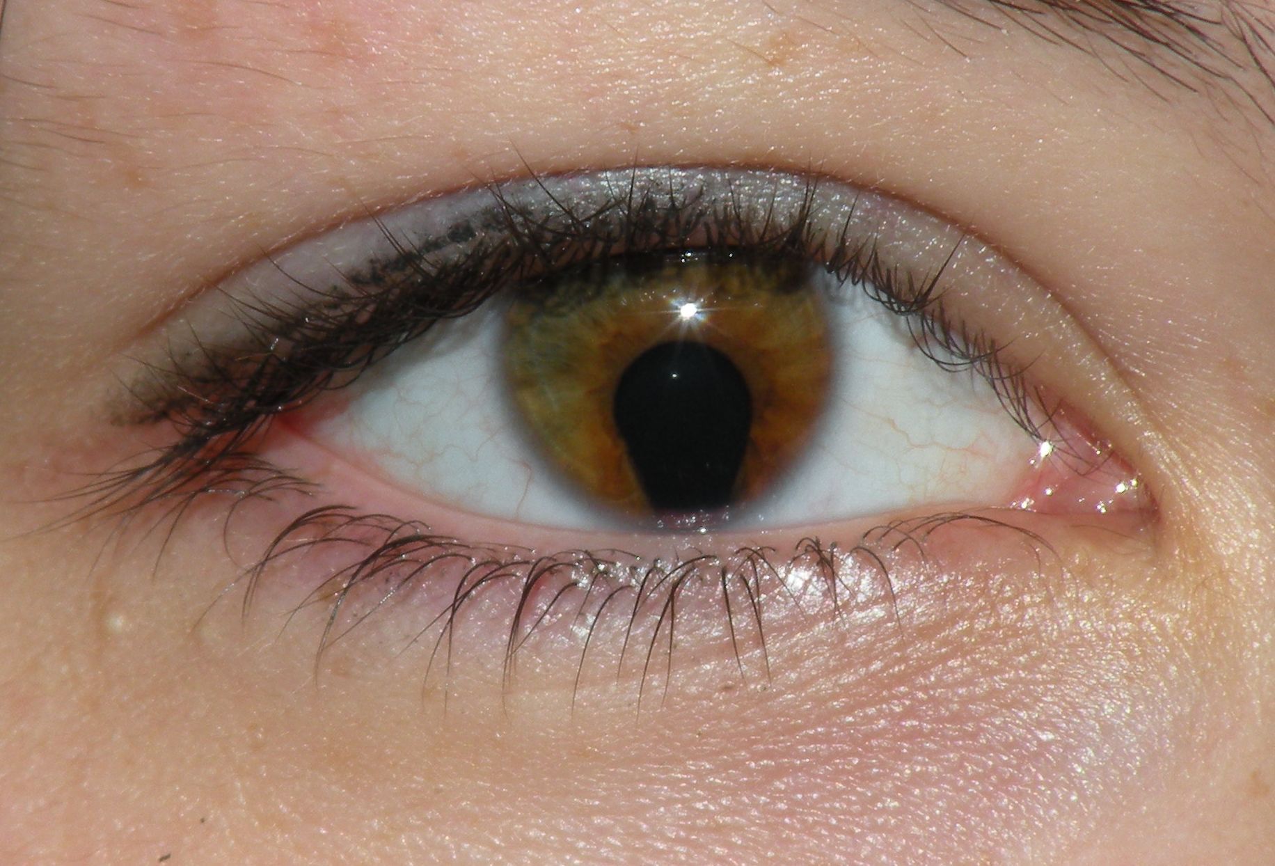 Coloboma_of_the_iris.jpg