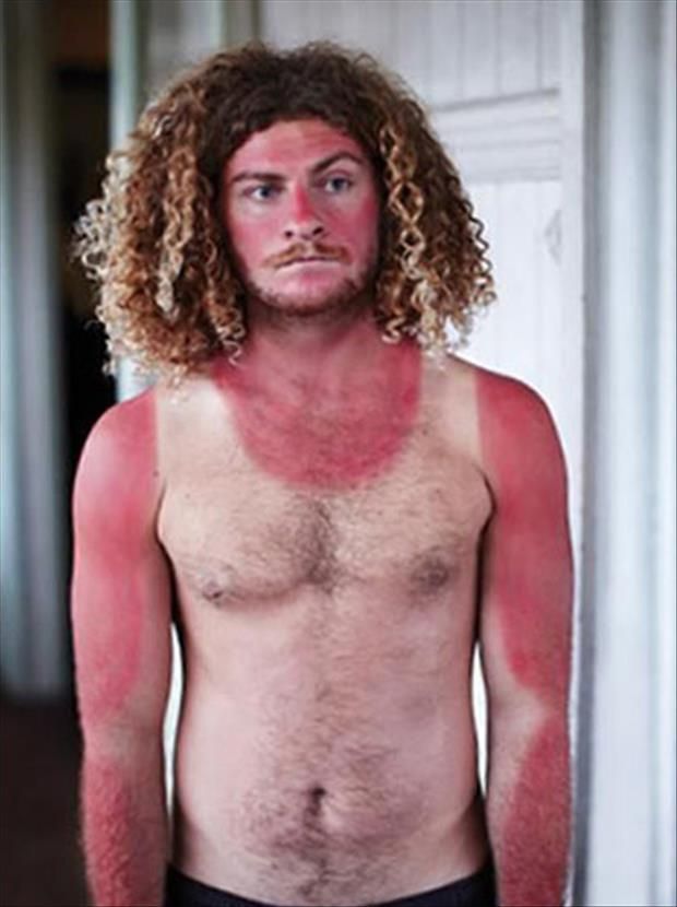 funny-sunburn-bad-sunburn.jpg