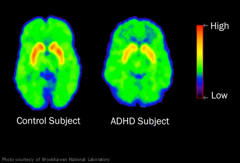 add-adhd-brain-scan-mind-child-chemical-imbalance.jpg