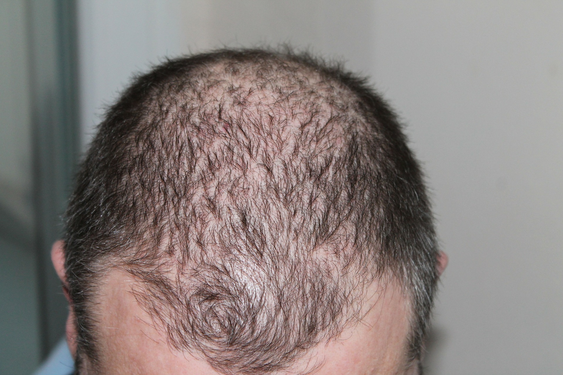 Should You Suffer From Thinning Hair You Have To Consider Eating