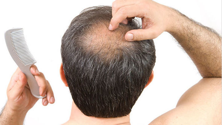 Hair-loss-A-hair-surgeon-has-revealed-if-home-remedies-to-cure-balding-actually-work-797404_720x405.jpg