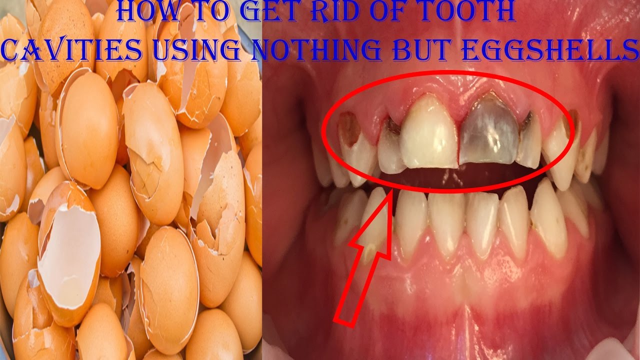 teethcavities-eggshells.jpg